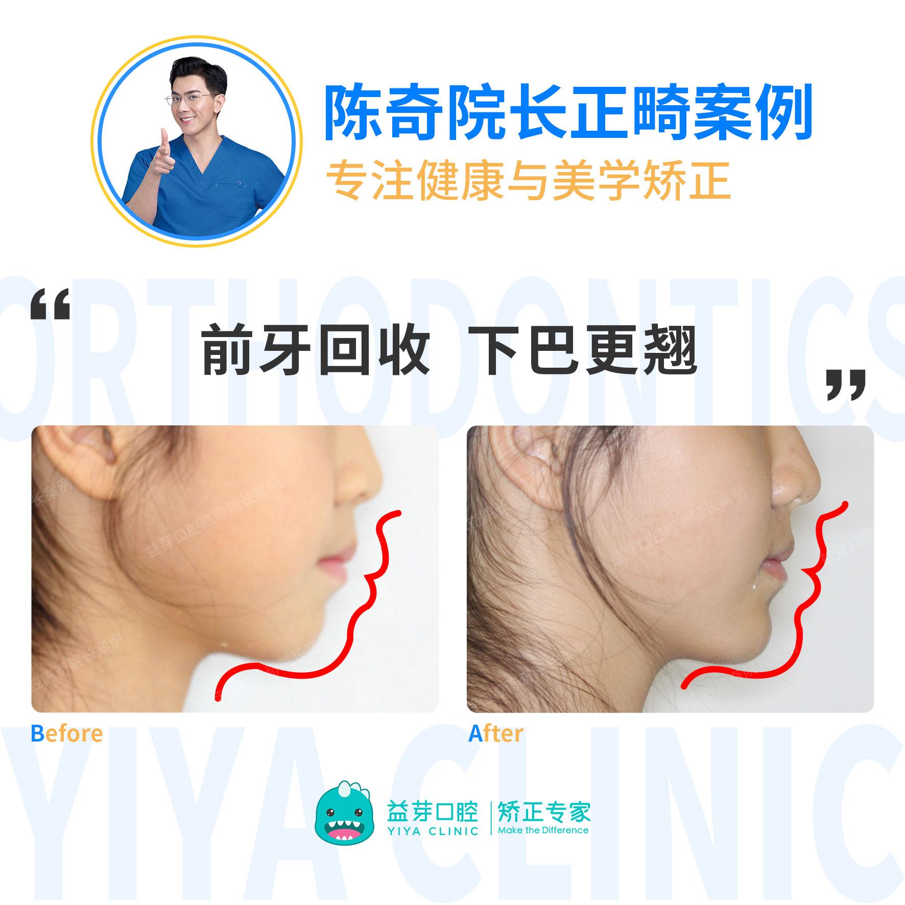 的想法: 经常在正畸医生的科普和案例里看到"控根移动"这个词