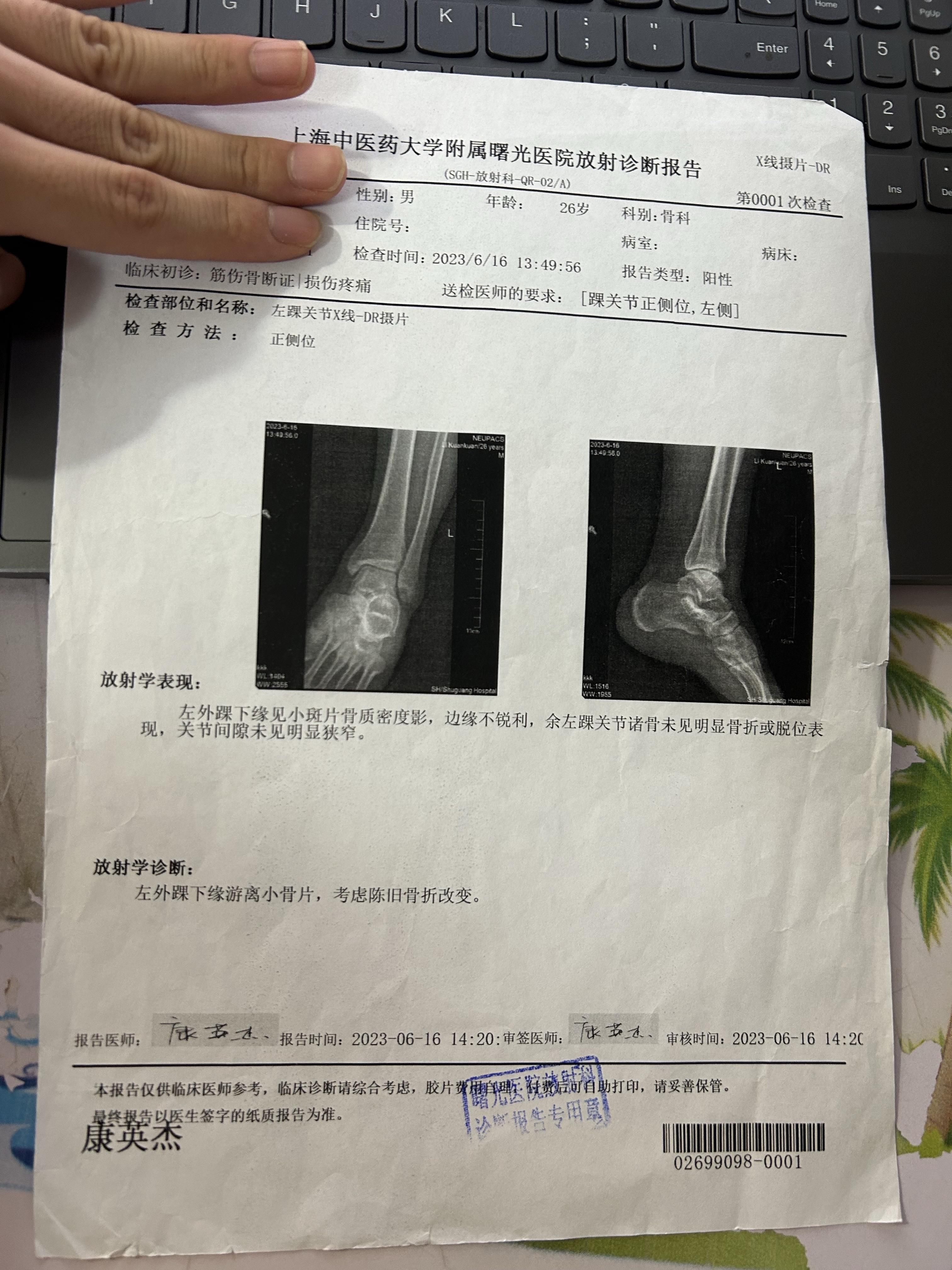 左外踝骨折图片图片