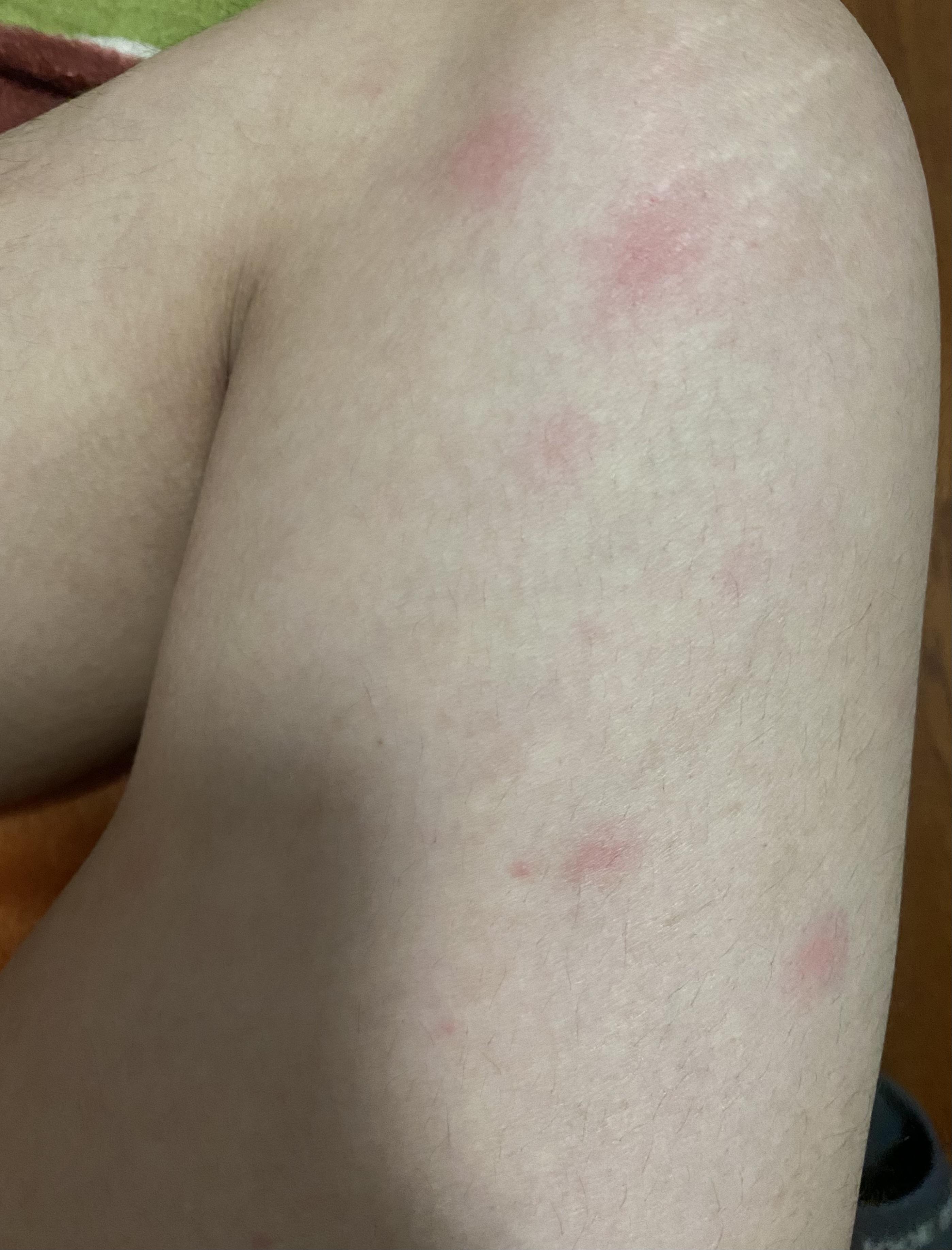 有没有人治好过这个结节性红斑大腿小腿处出现一些红斑硬结极其容易