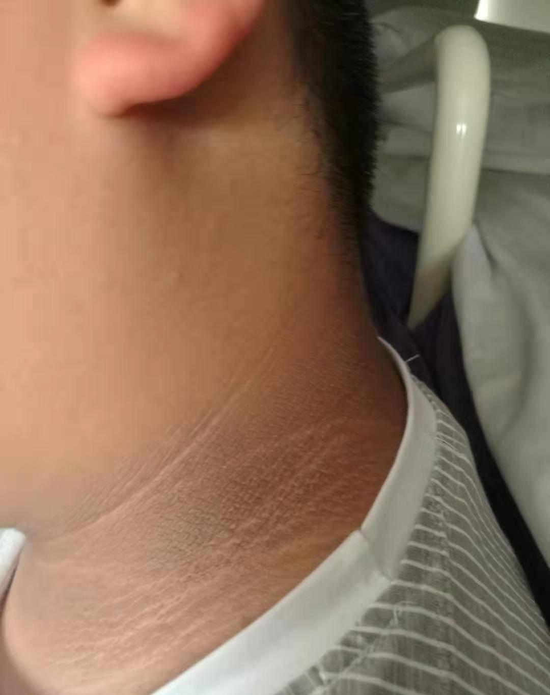 营养师王丰收 的想法: 一个客户的孩子,脖子部位皮肤变黑,咨询过许多