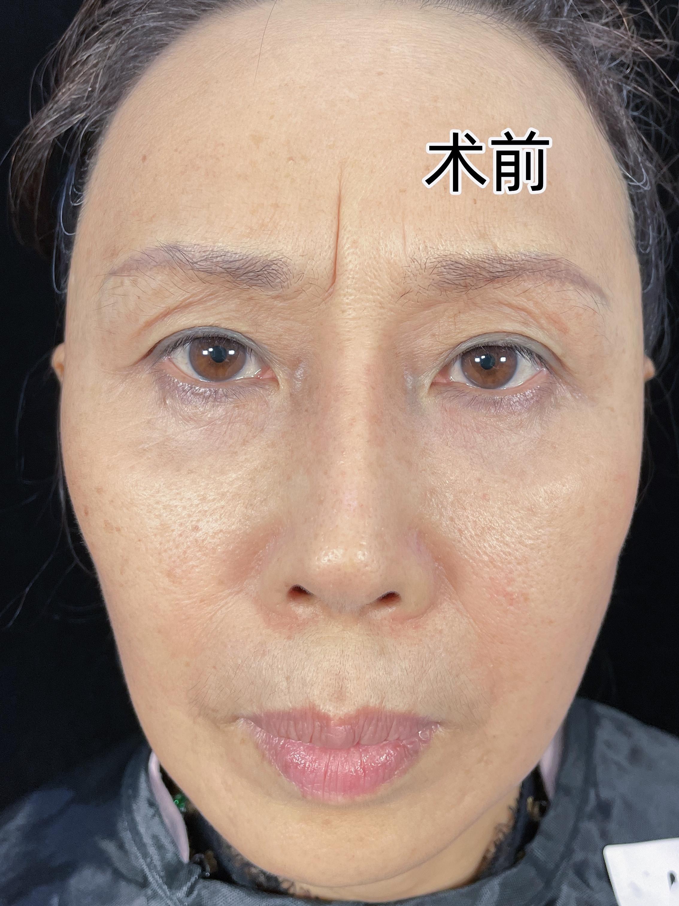 六七年的顽固型川字纹一个小时就消除了我的川字纹已经有六七年了用过