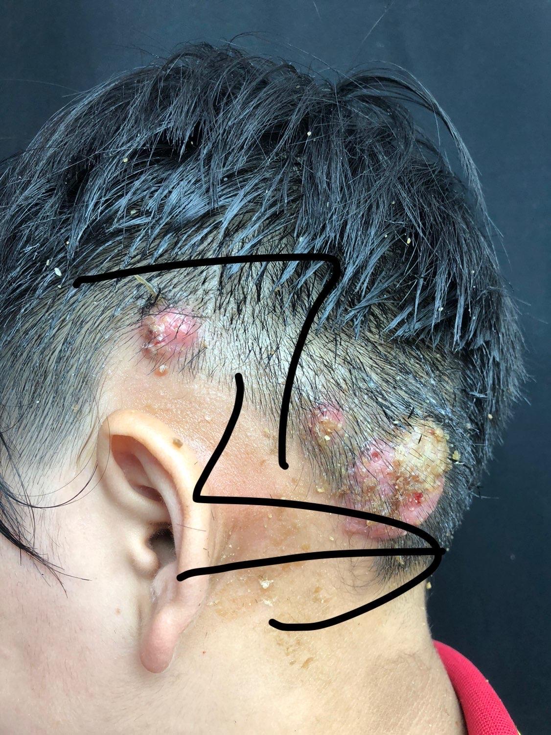 患儿1个月前头皮出现红斑,因无明显自觉症状未就诊;1周前