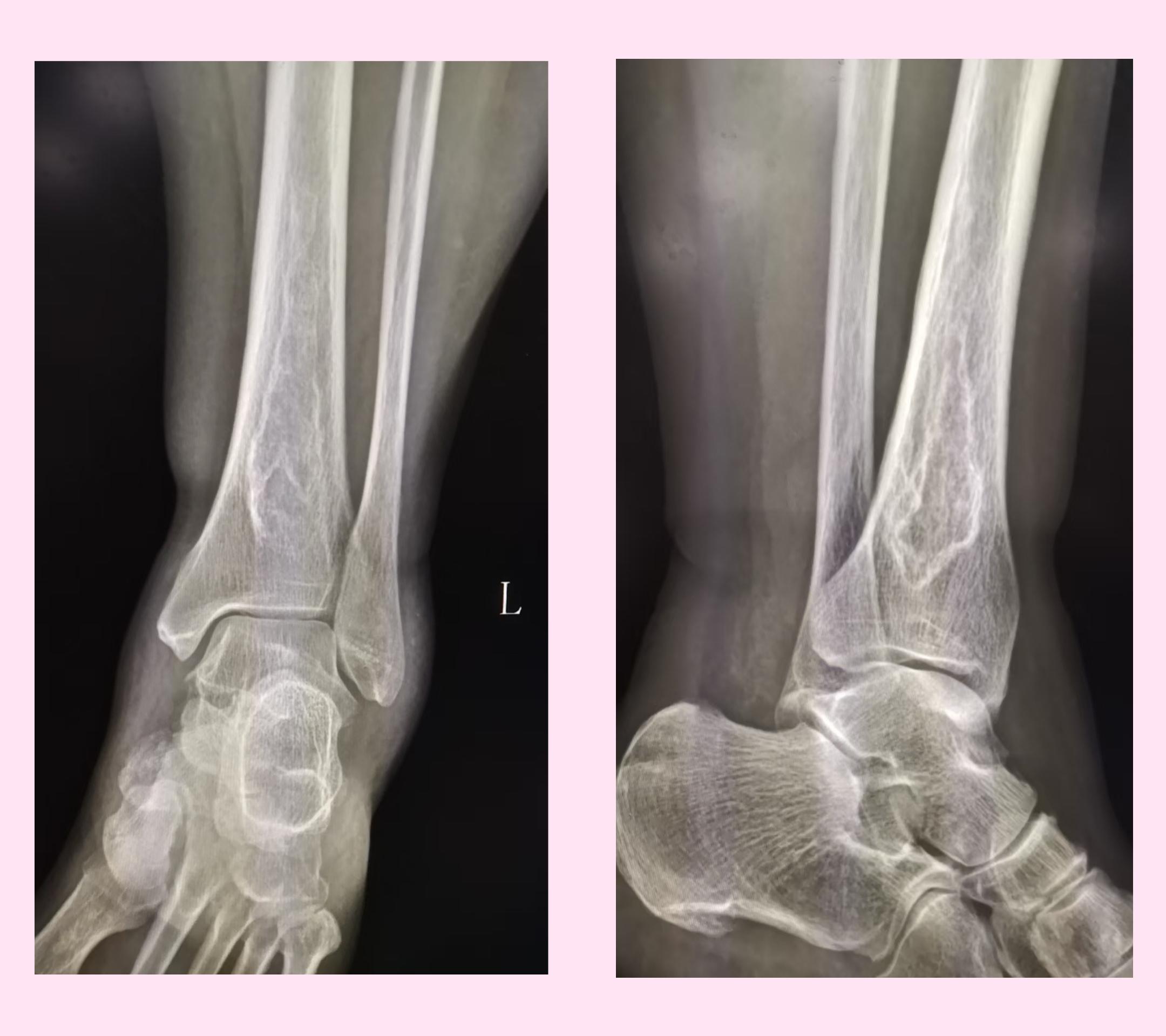 踝关节正侧位(典型病例:骨梗死)