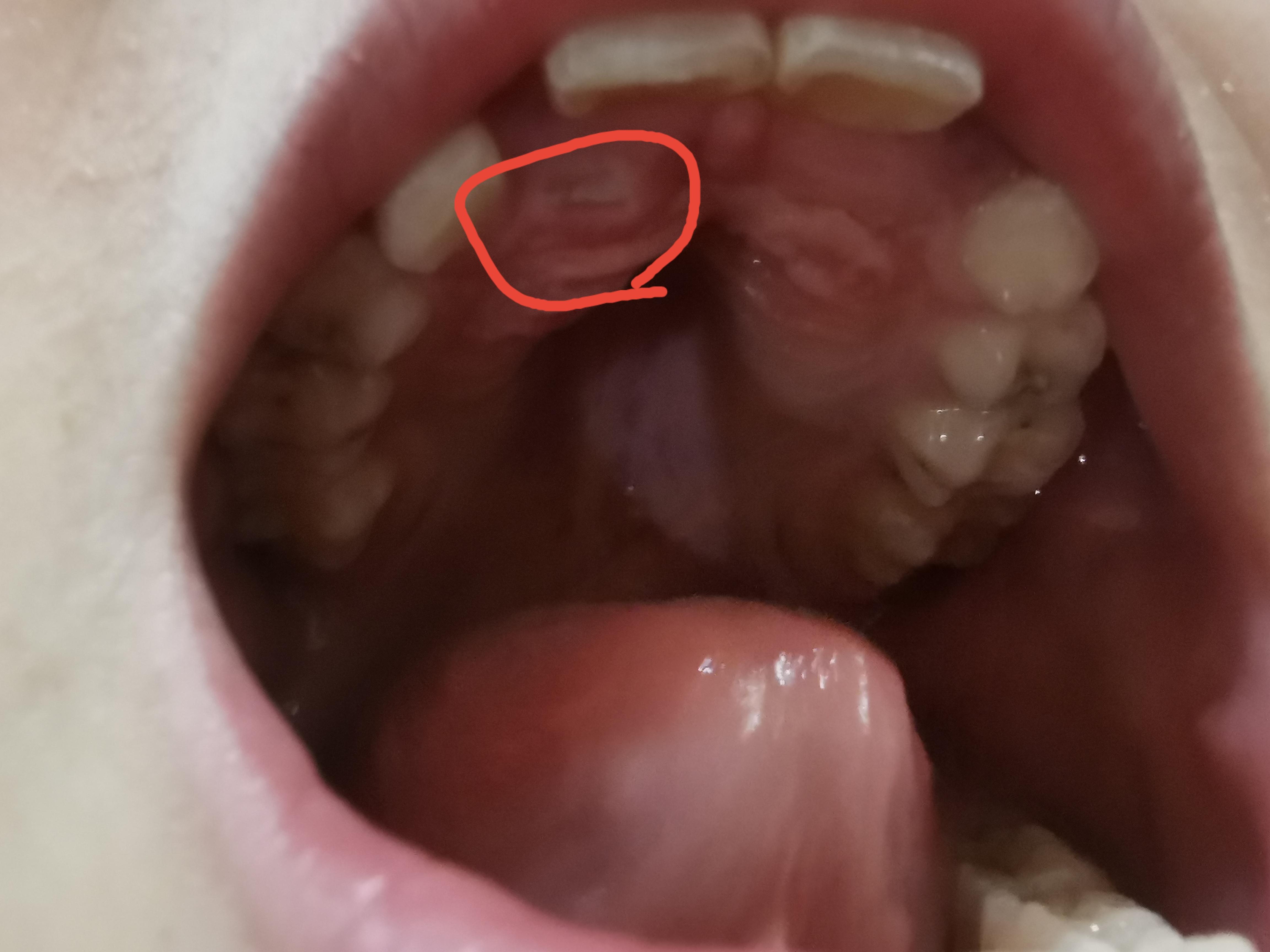 蓉小饭 的想法: 8岁孩子牙齿乳牙去年脱落后迟迟不长,昨天发现上颚上
