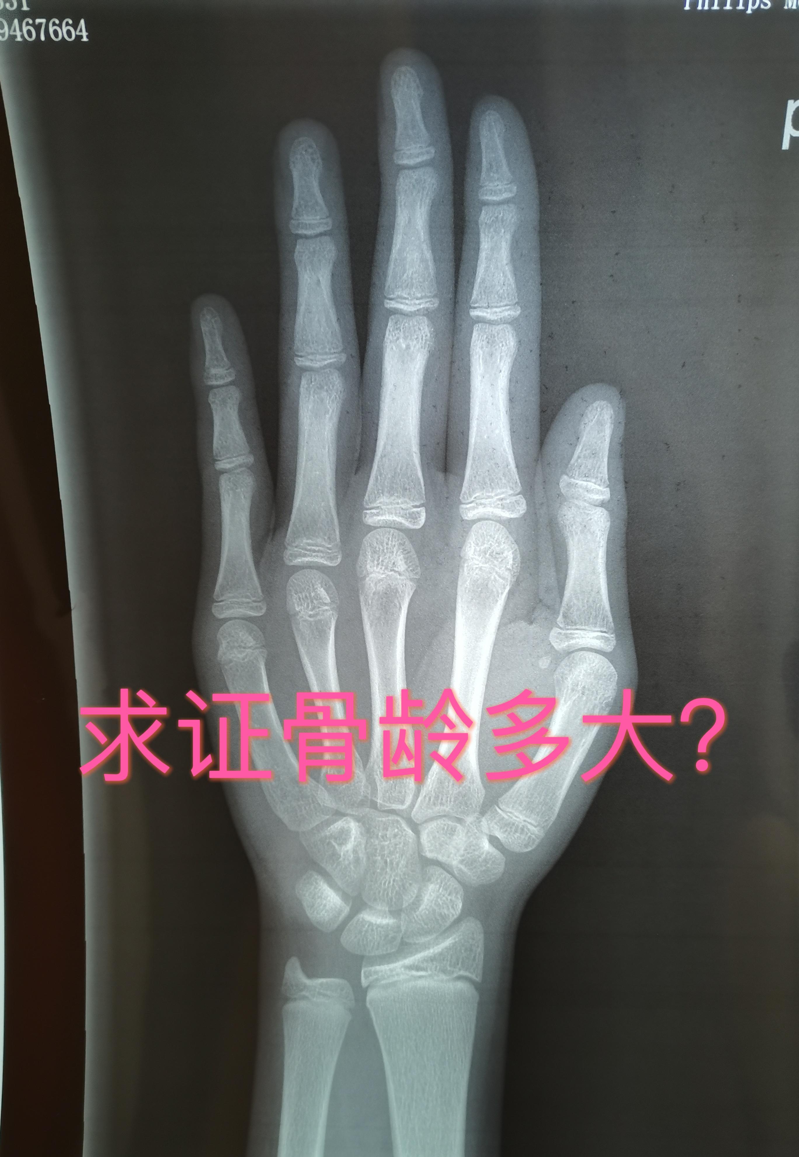 骨龄鉴定程主任 的想法: 求证骨龄多大?