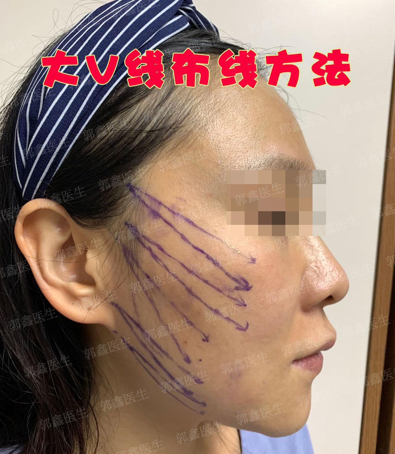 郭鑫医生 的想法 为何拉皮手术后表情有些僵硬小切口筋膜悬吊+大v线