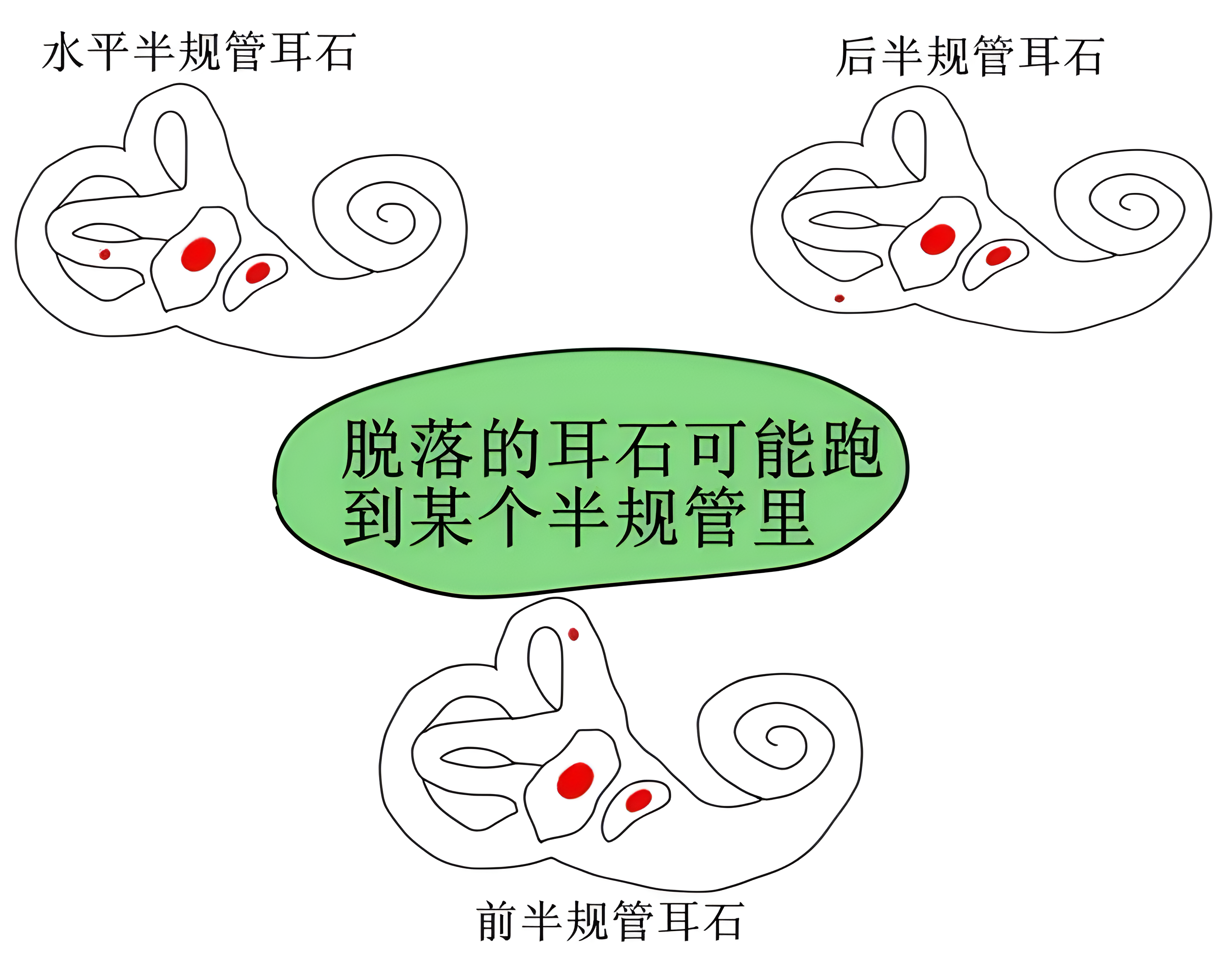 医学研究生 的想法: 什么是耳石症?