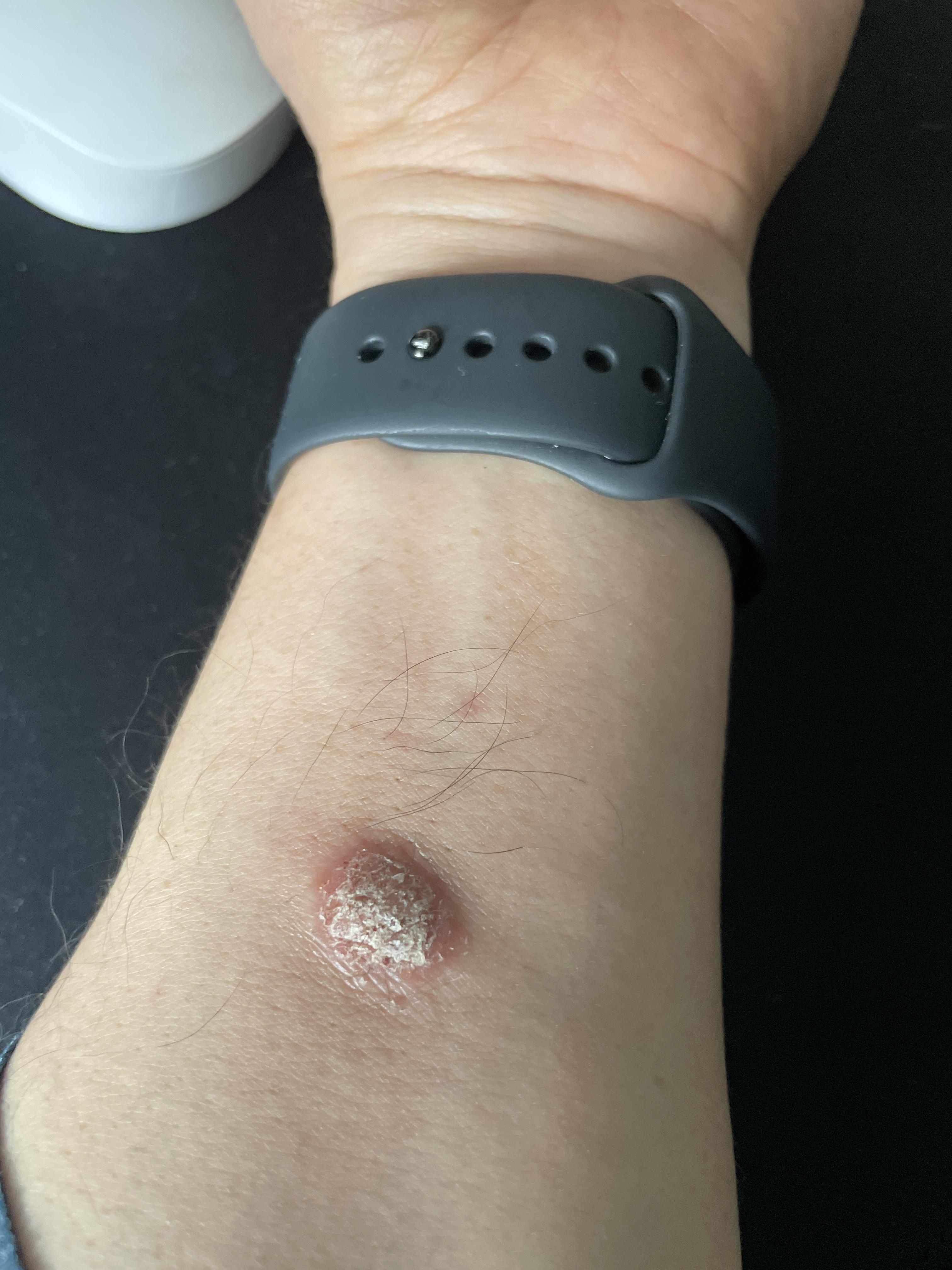 怎么治疗手臂上的这个顽固性湿疹