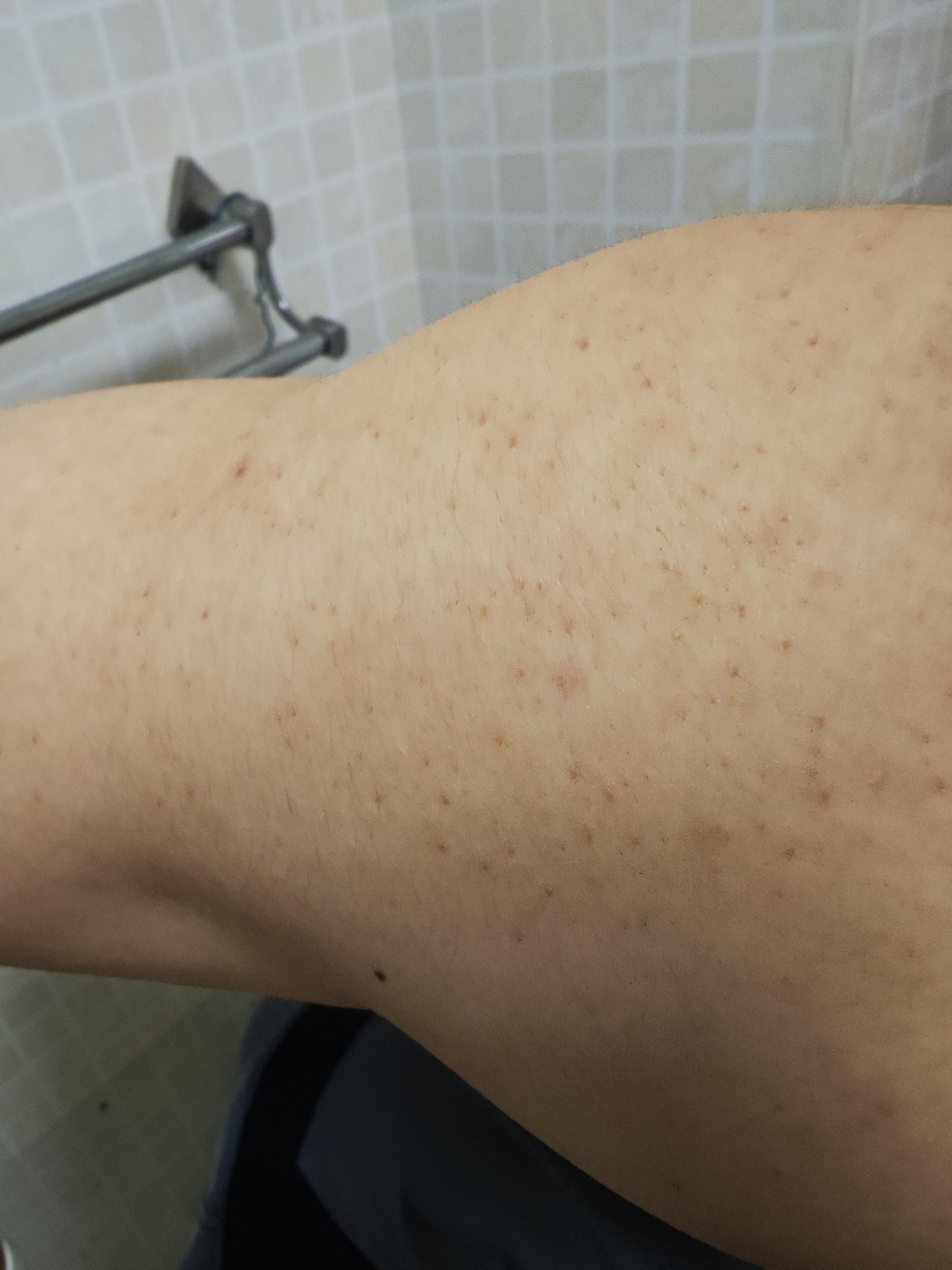 林夕爱健身 的想法: 请问我肩膀上的毛孔为什么这样?