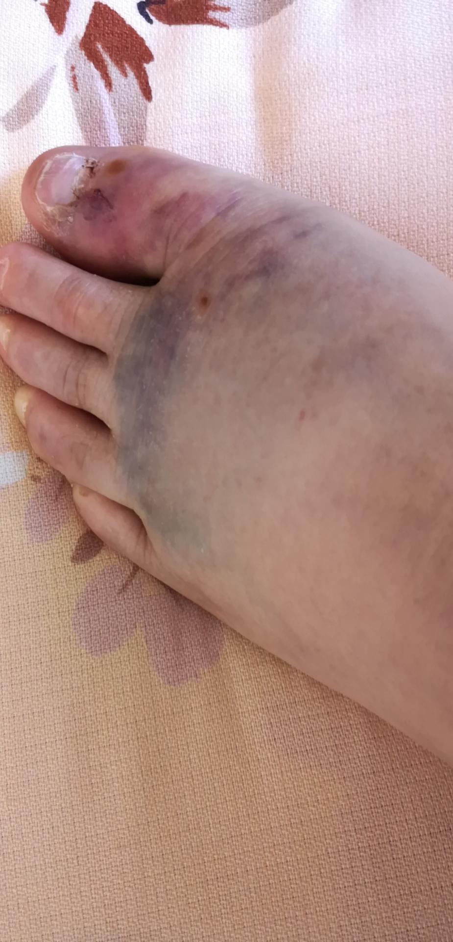 有淤血,拍片检查没有骨伤,用采血糖的针,在旁边刺血,两小时后,明