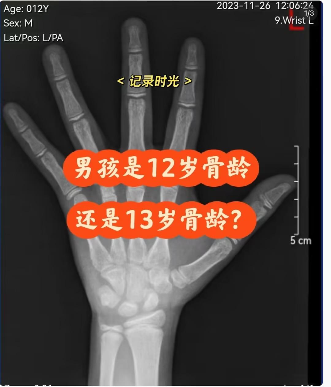 骨龄正常为什么性早熟 骨龄正常为什么性早熟