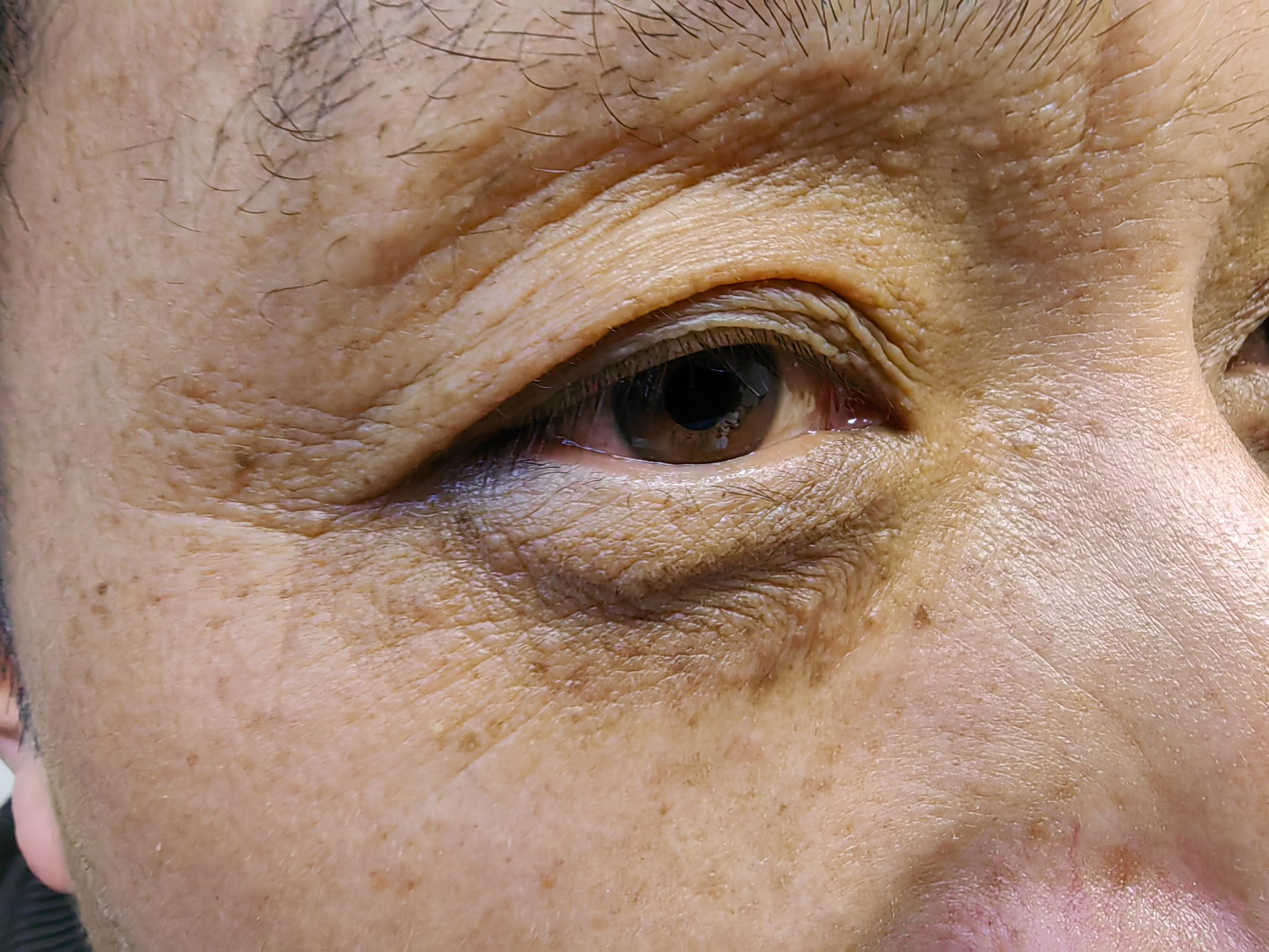 护肤在西塘 的想法: 黑眼圈,小疙瘩,眼周衰老怎么办?