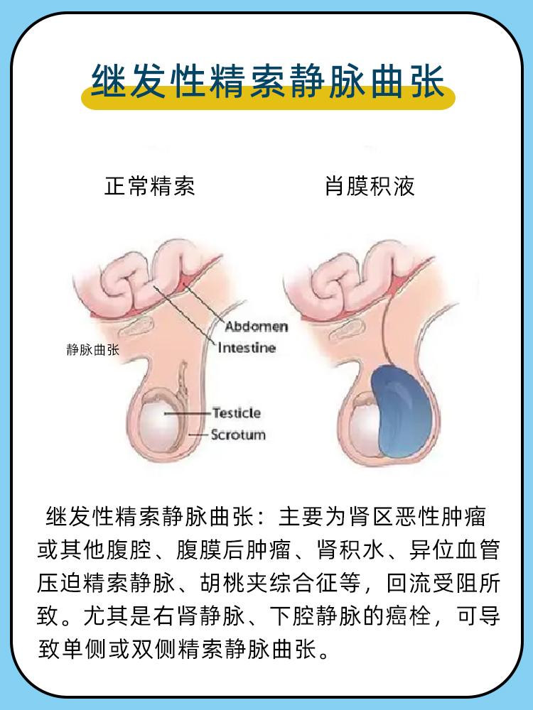 精索静脉曲张是指精索内静脉因流量增大或回流不畅等原因导致返流