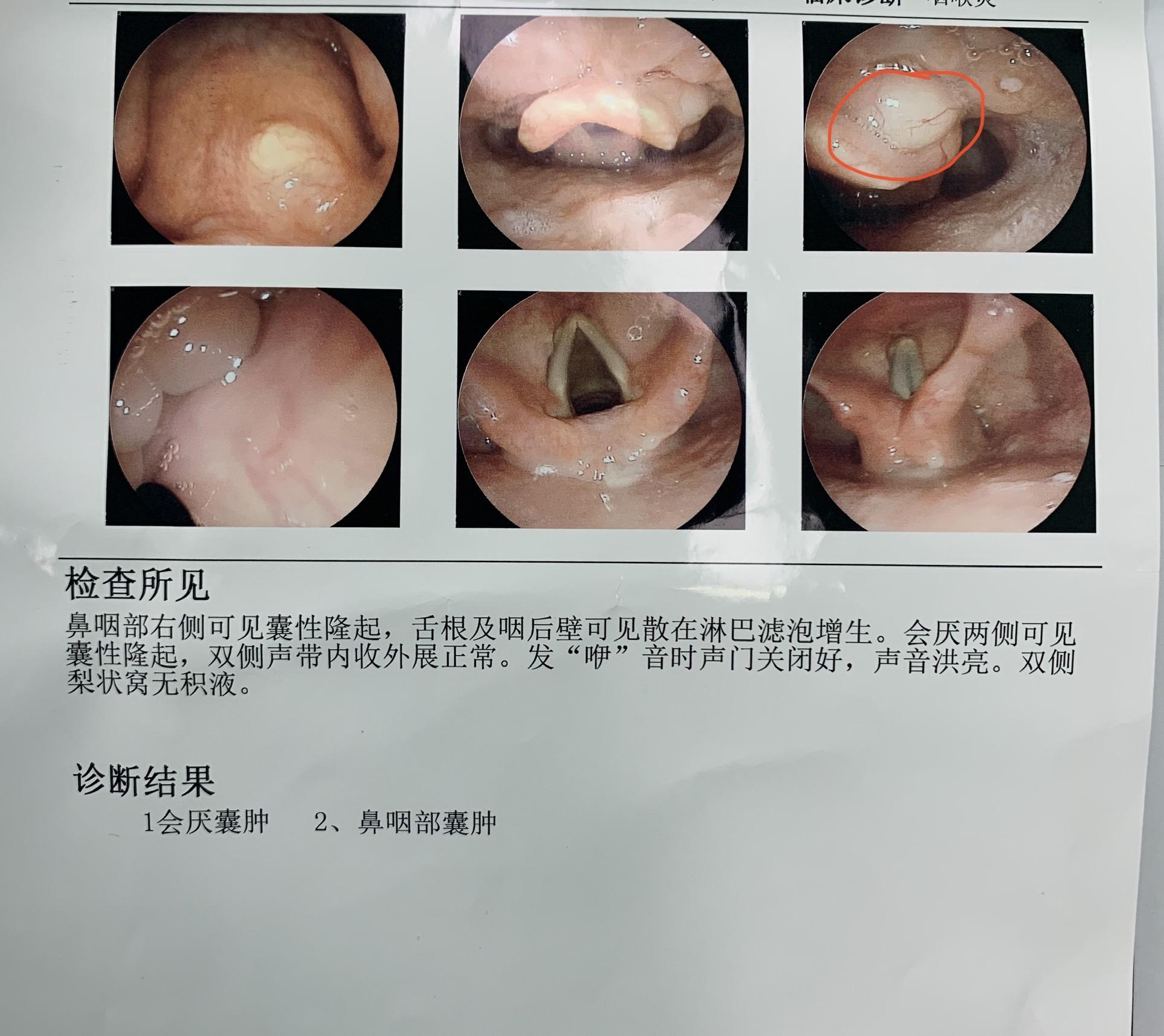 会厌囊肿早期图片图片