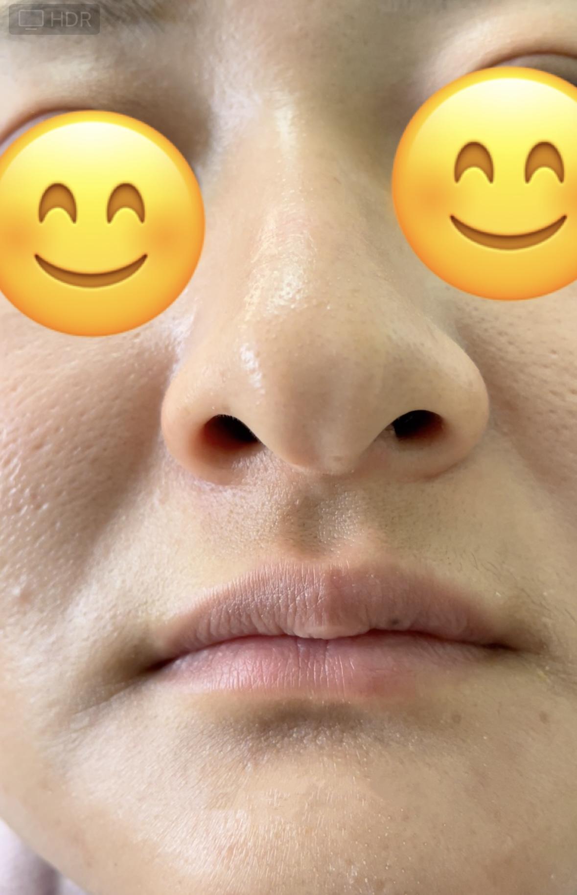 范荣杰鼻整形 的想法: 东亚女性鼻翼软骨如此清晰的不多,属于典型的"