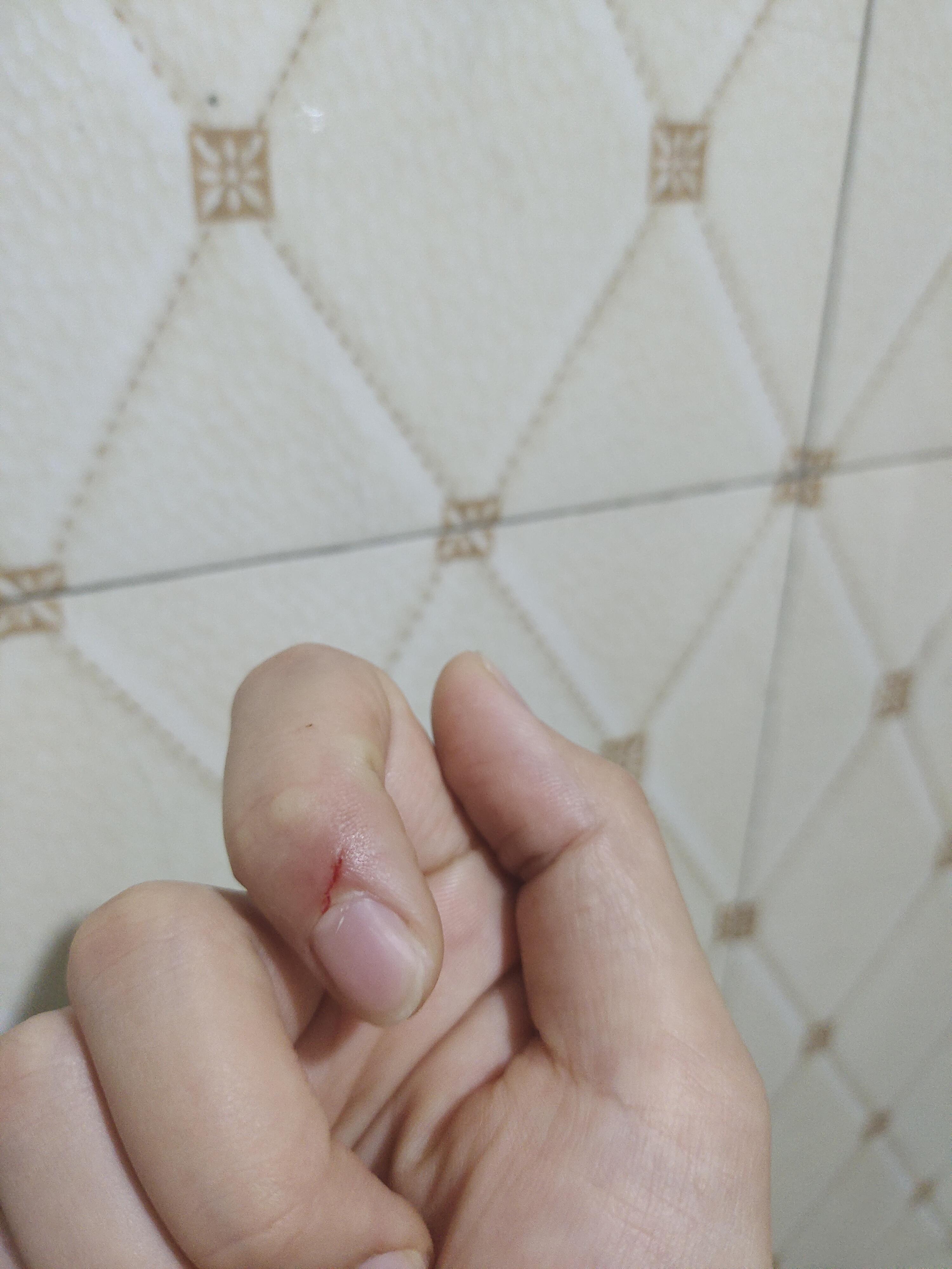 手指被铁丝划破了,要不要打破伤风?