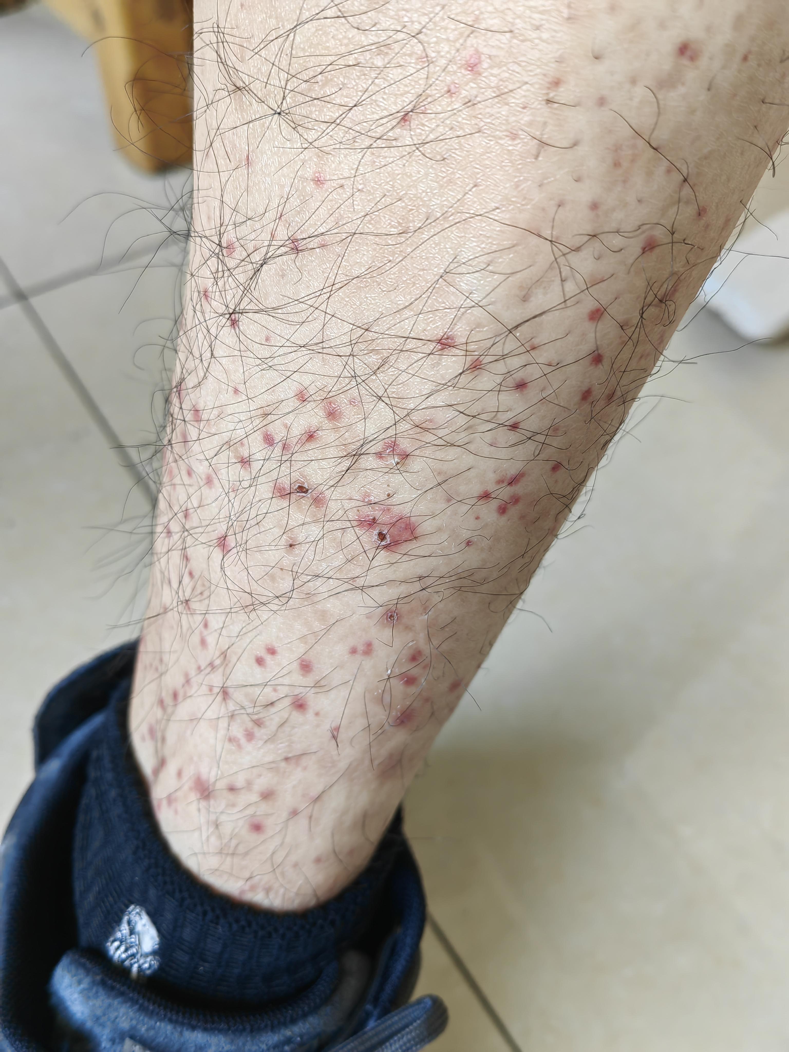 冬天是过敏性紫癜的好发季节,该病常见于呼吸道等感染后,并非真的