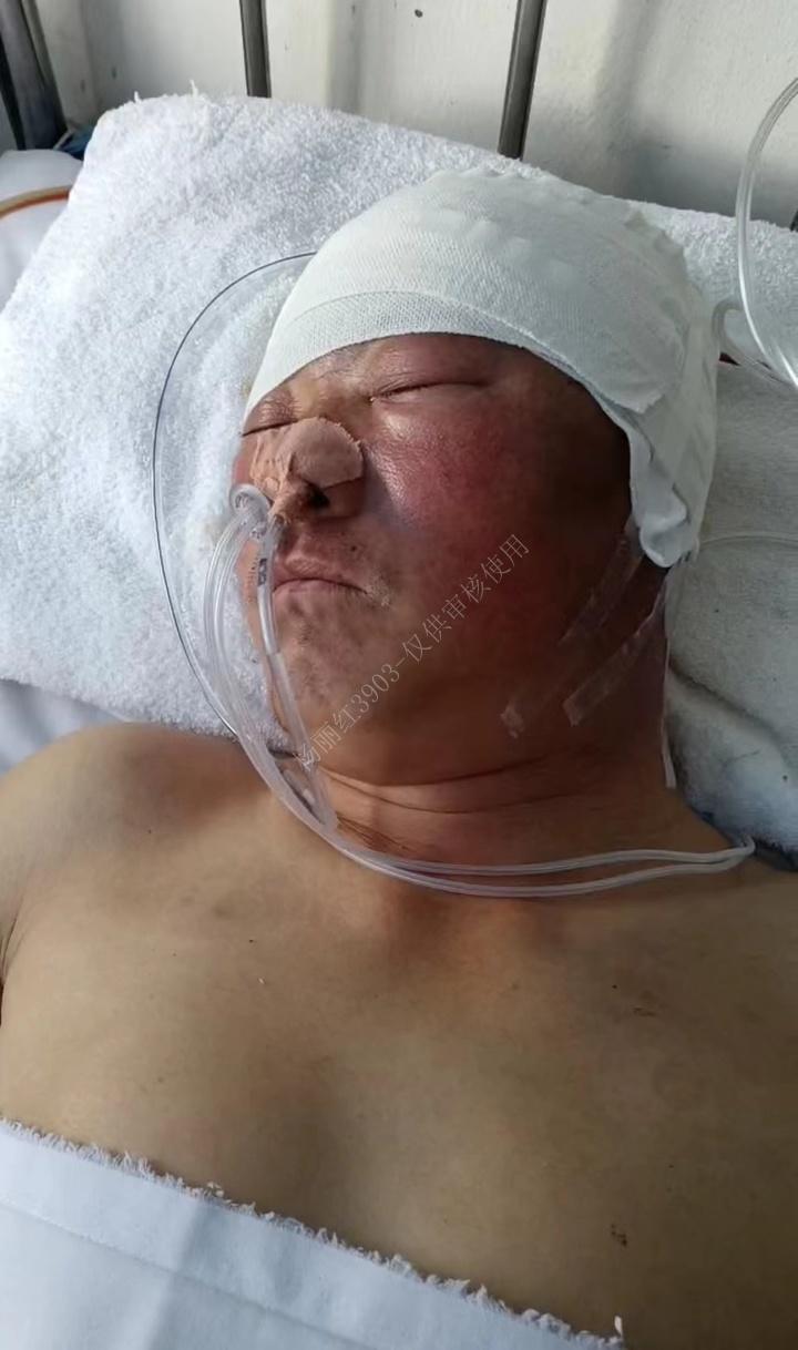 郭振波【脑出血】两次开颅危急,求助