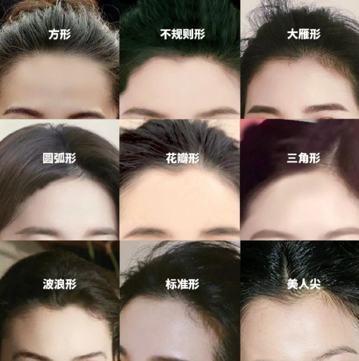 小柒聊植发 的想法: 发际线形状分享