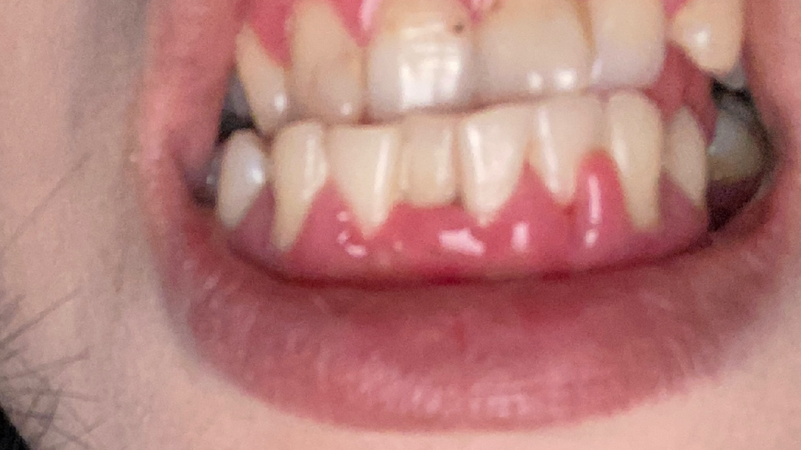 主公姐姐 的想法: 牙肉是什么原因引起的 | 牙肉今年突然这样子,是