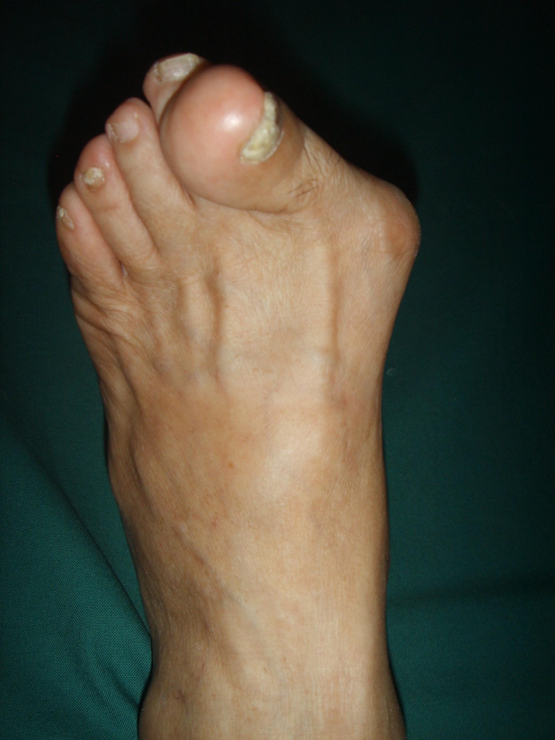 大脚骨整形专家 的想法: 有的拇外翻脚趾会钻入第二趾的下方, br>但是