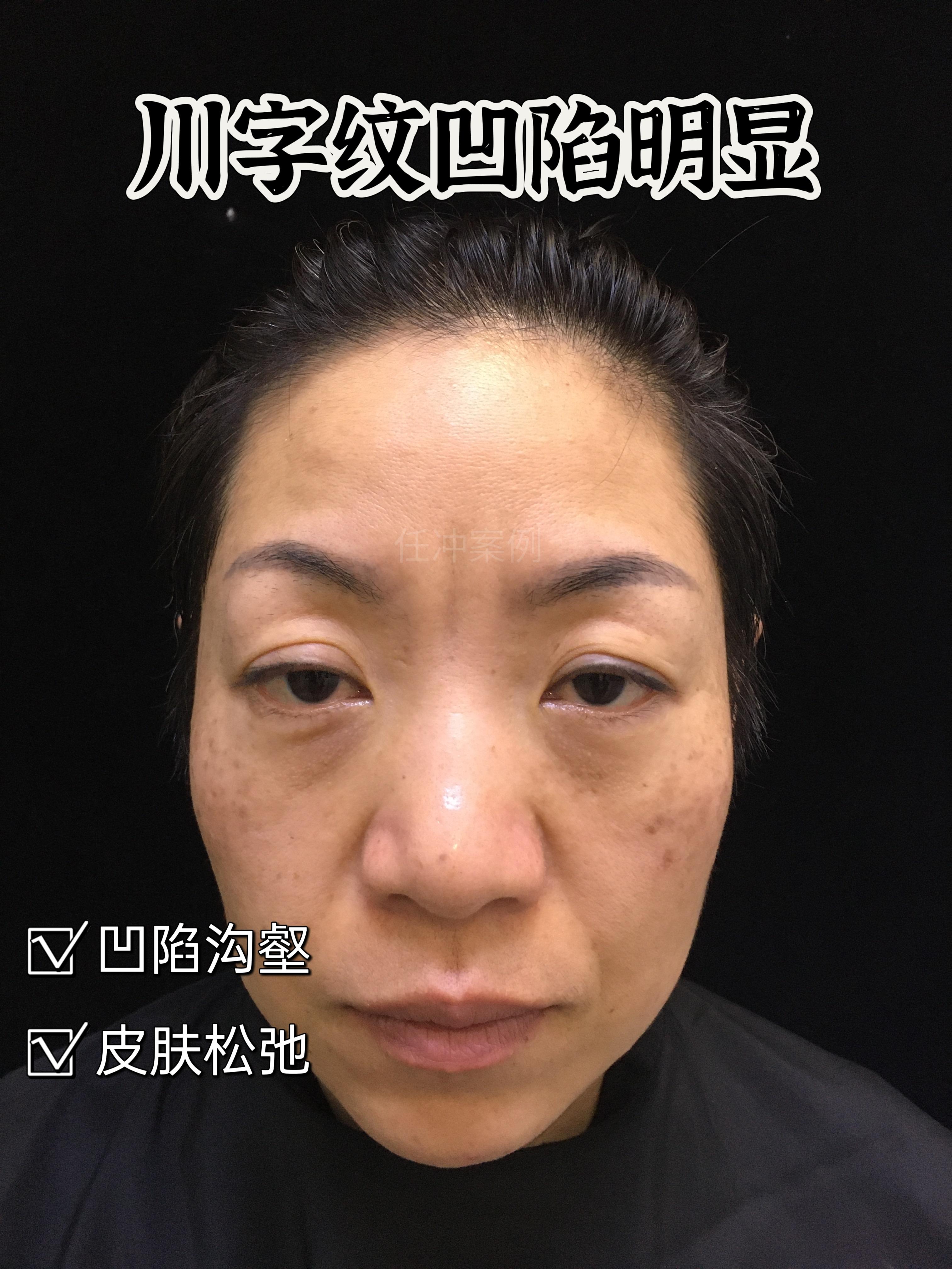 美容整形去除眉间纹的方法（美容整形去除眉间纹的方法视频） 美容整形去除眉间纹的方法（美容整形去除眉间纹的方法视频）《去除眉间纹价格》 整形美容