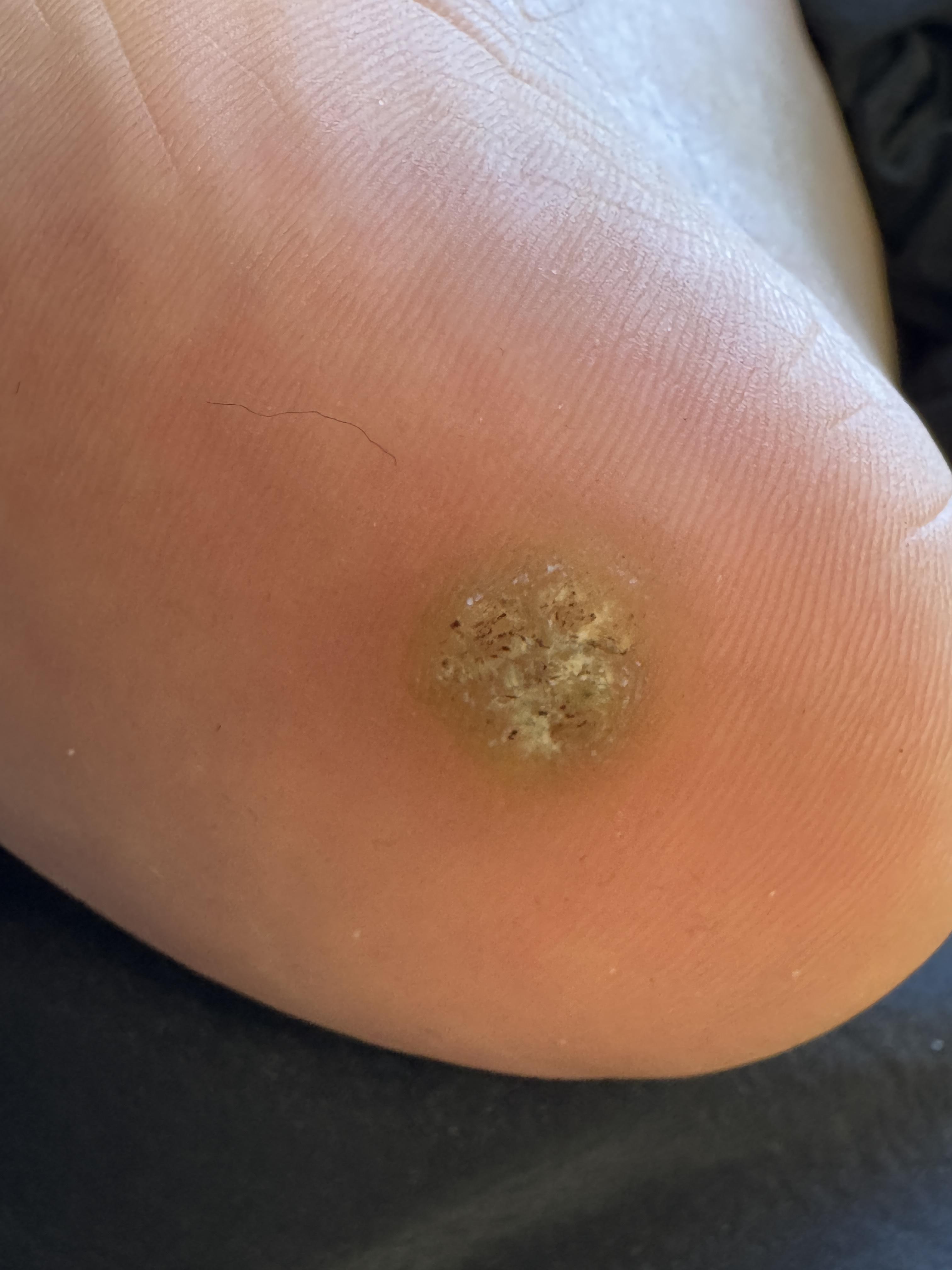 护肤在西塘 的想法: 脚底的"鸡眼",其实是hpv感染!