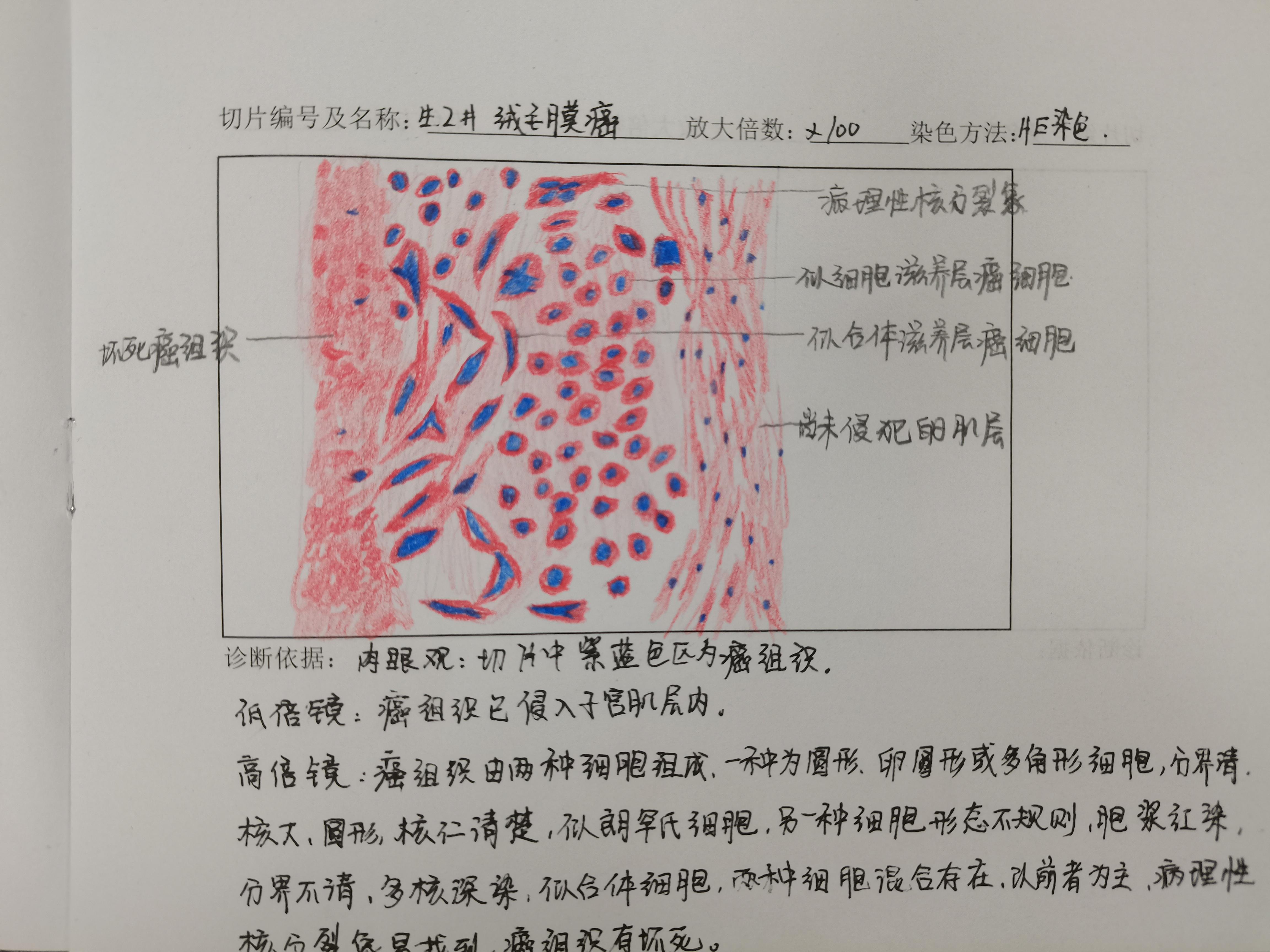 葡萄胎切片绘图图片