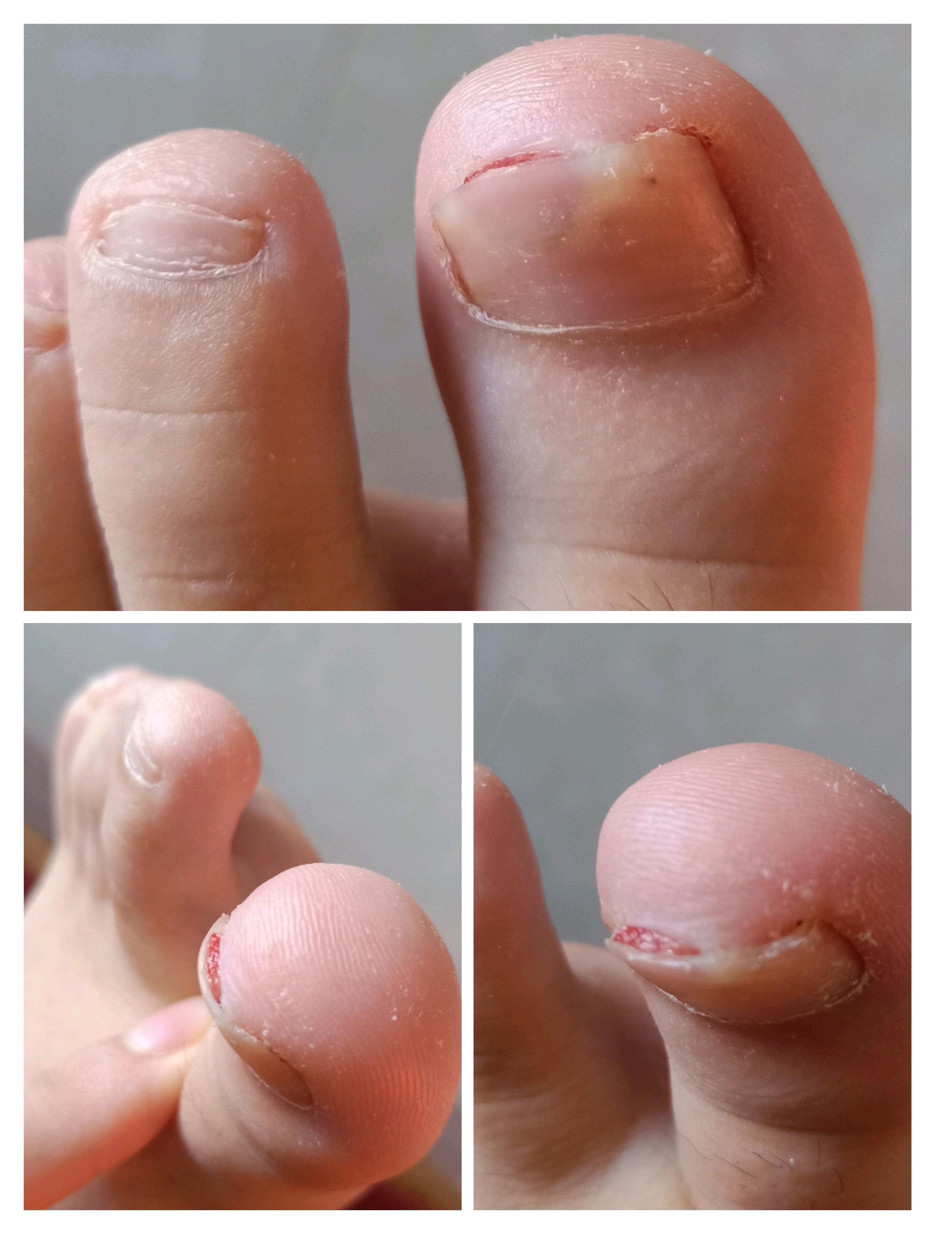 放多了盐的鱼好咸 的想法: 求助贴,脚指甲出现肉芽,怎么办