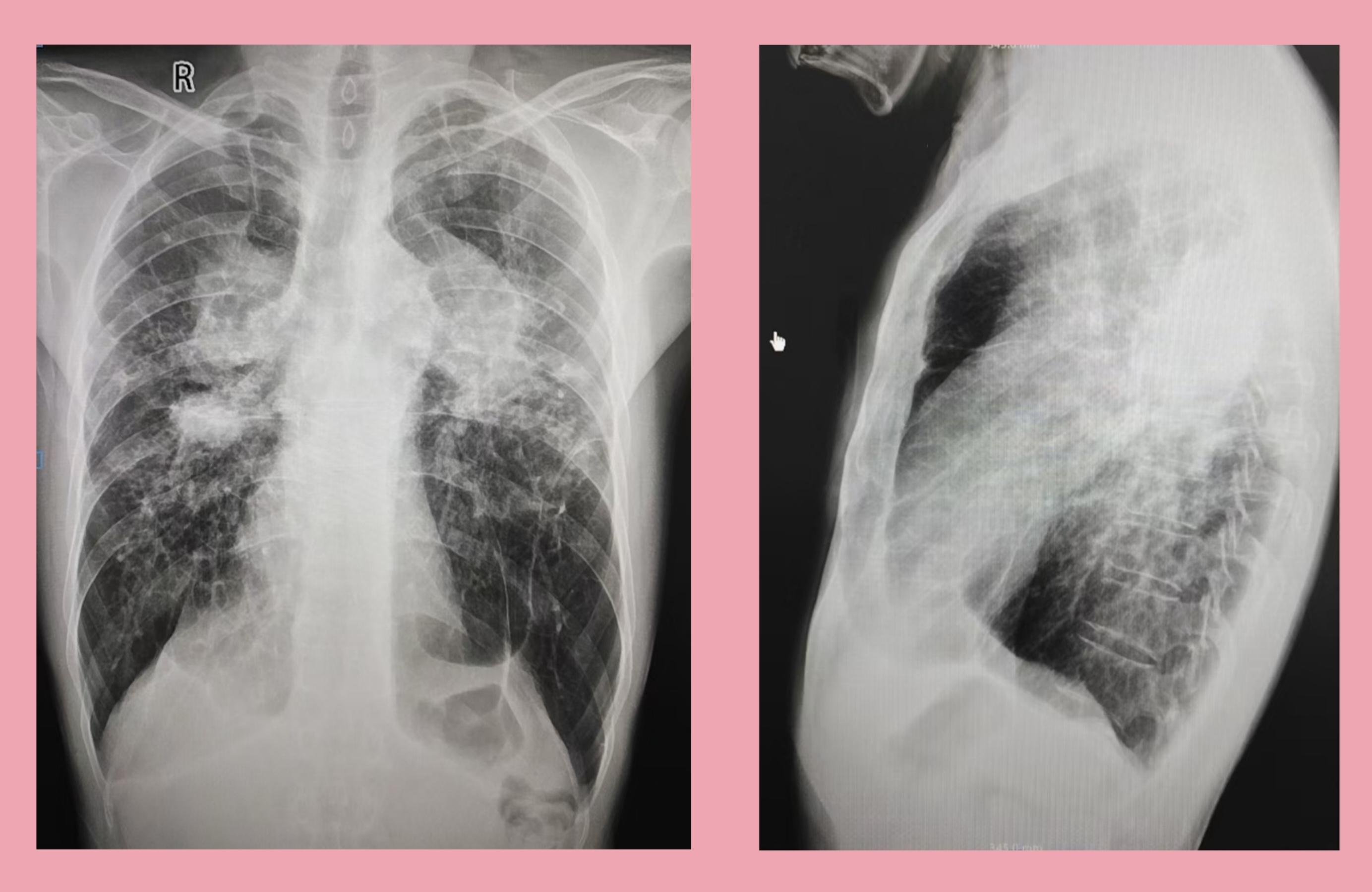 胸片病变典型尘肺表现影像描述