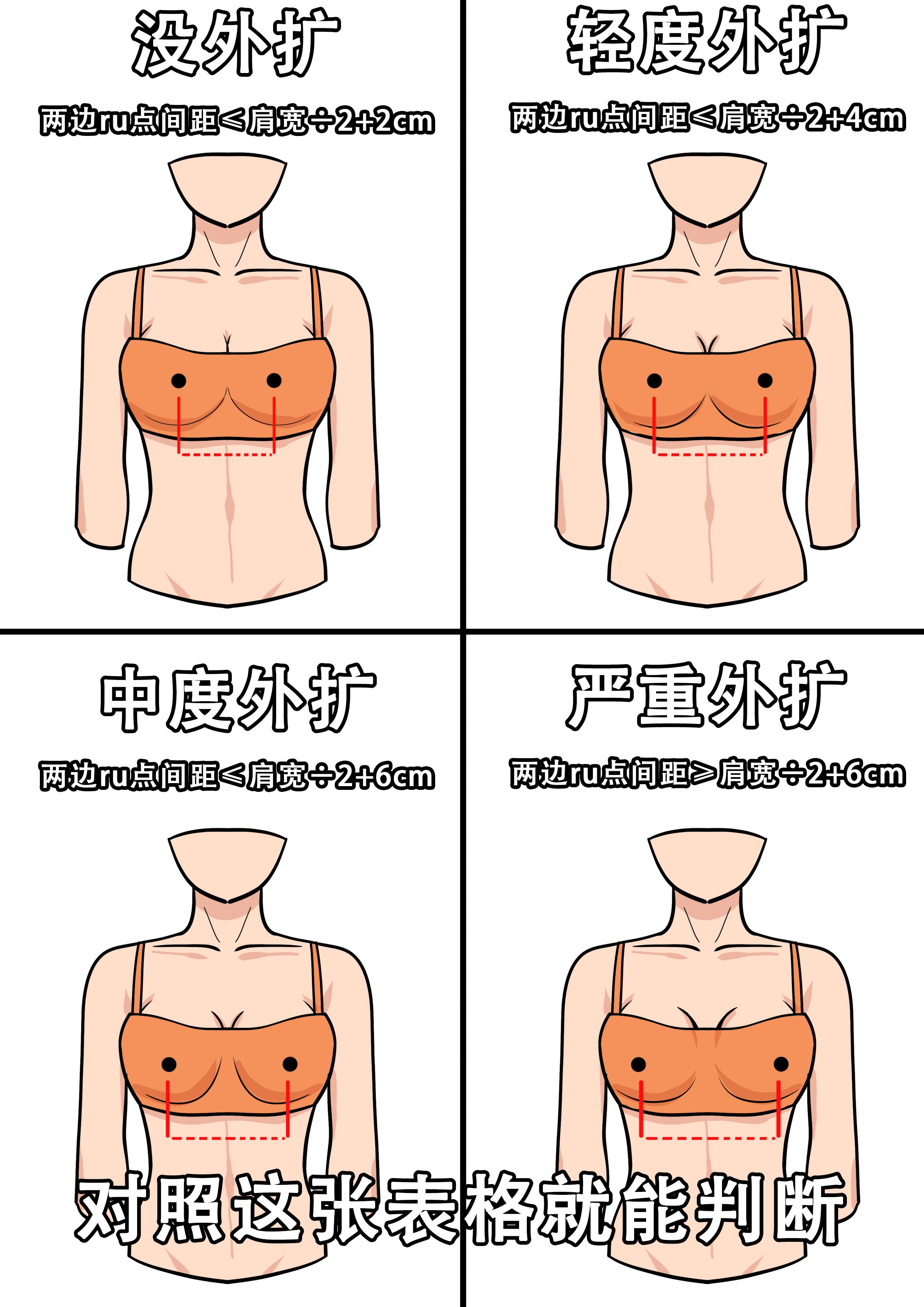 如何判断是否是93外扩?93型外扩是指ru房向两侧长.