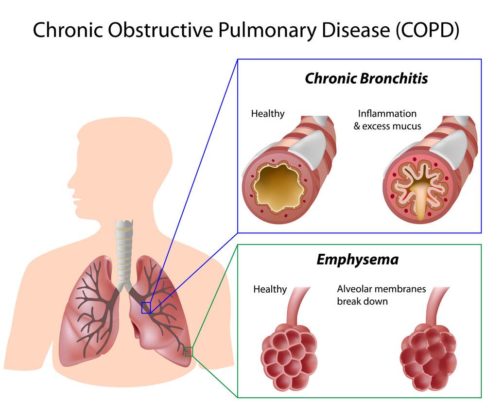 Definition Acute Exacerbations Of Chronic Obstructive Pulmonary Disease