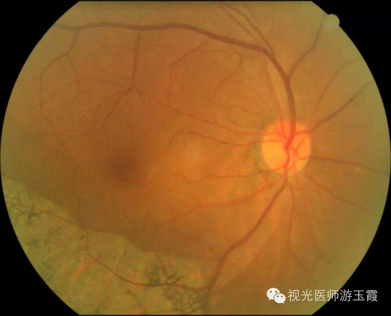 别让糖尿病伤了眼！糖尿病视网膜病变，做到“三早”避免视力丧失|糖尿病|视网膜病变|视力_新浪新闻