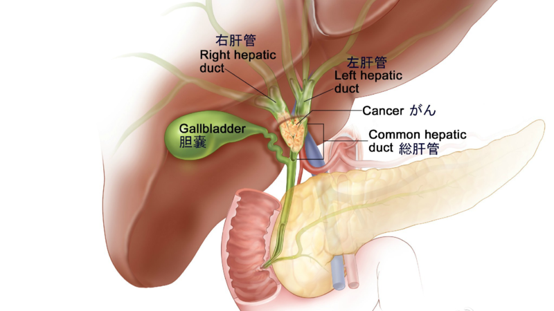 胆囊癌的遗传突变和靶向药物 知乎