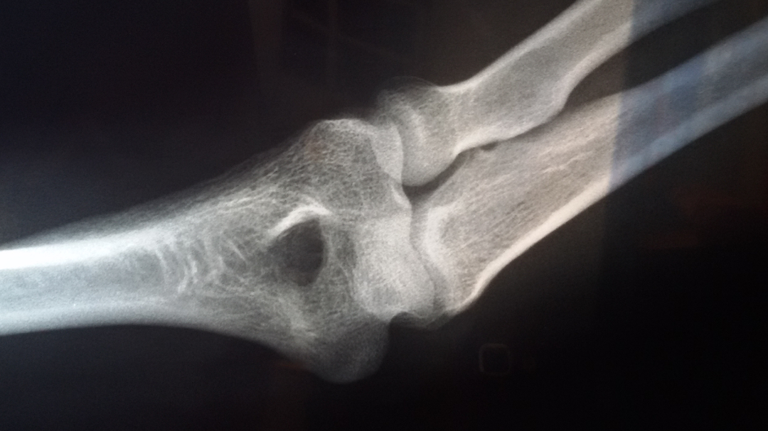 "左胳膊肘:左桡骨小头后侧不连缘,肱骨小头后缘部分缺损,疑是骨折"