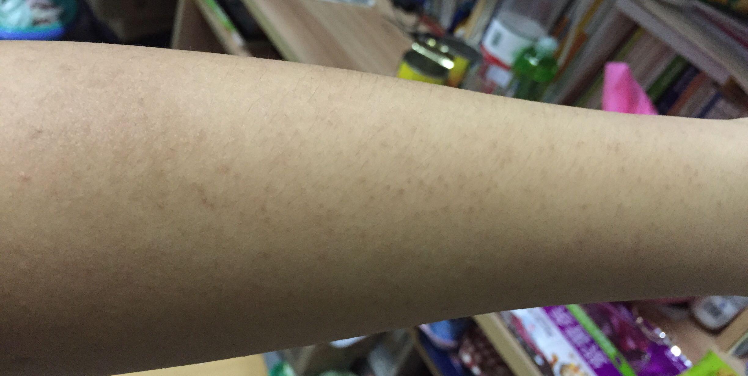 手臂上有很多颗粒,十四五岁的时候能挤出来白