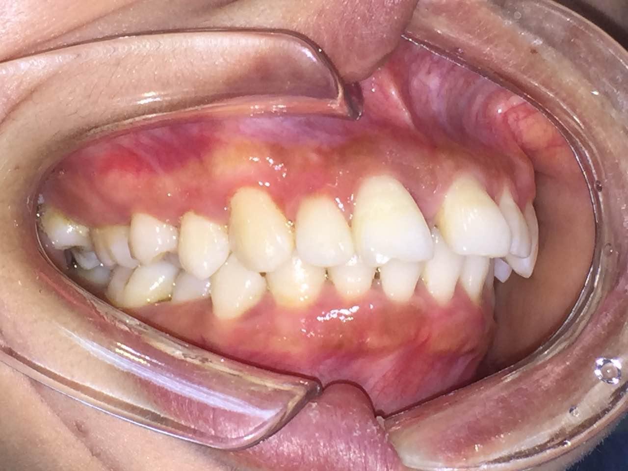 牙医们请看看我的牙齿咬合问题我咬门牙后面的牙咬合不起来咬后面下巴