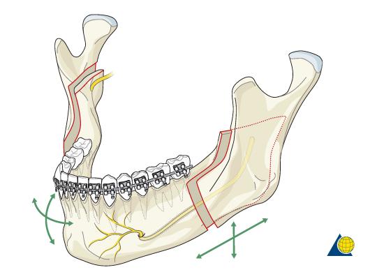 上颌lefort i 型截骨术(改善面中部外形),正颌手术术式很多,最常用的