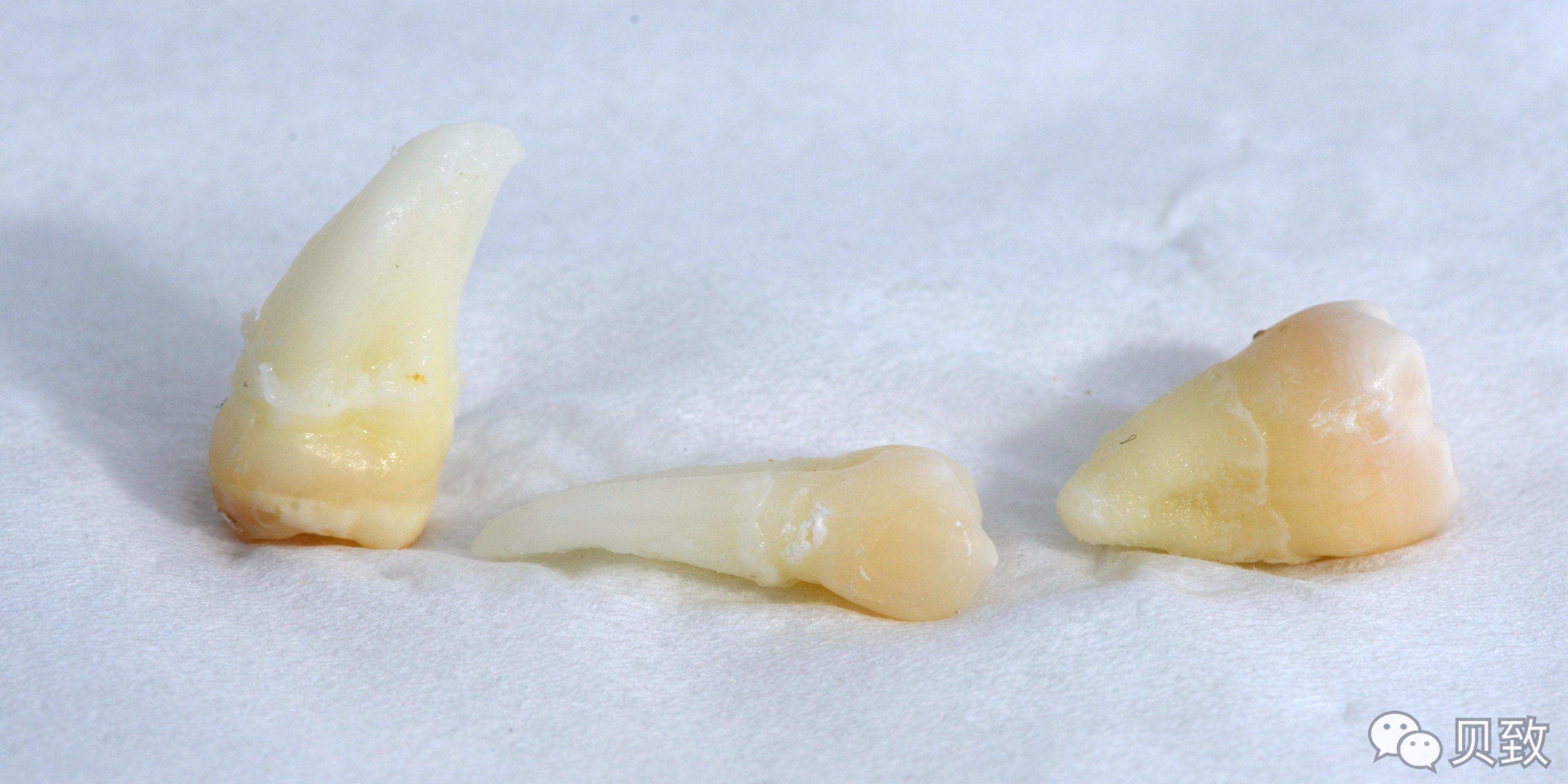 (转)谁能想到,饮料正在“谋杀”我们的牙齿 (转)谁能想到,饮料正在“谋杀”我们的牙齿