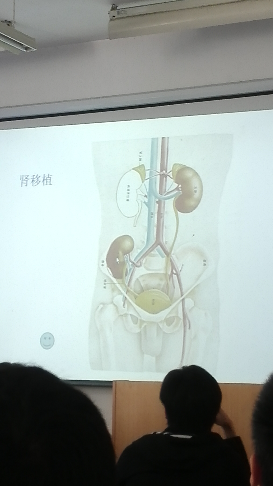 肾移植示意图图片