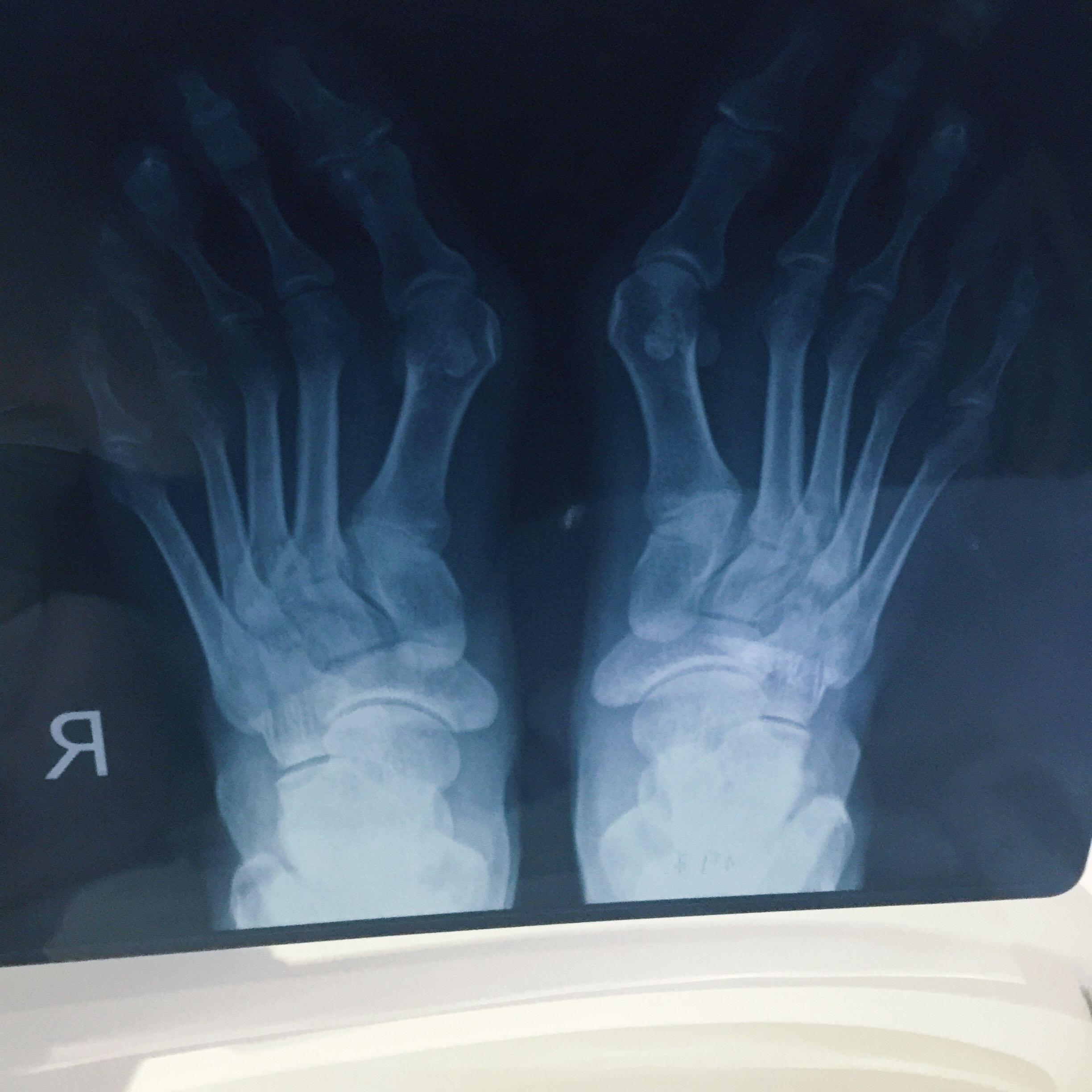 男子多个脚趾手指外翻畸形 类风湿性关节炎是“幕后黑手”_新闻动态_医院新闻_福州中德骨科医院