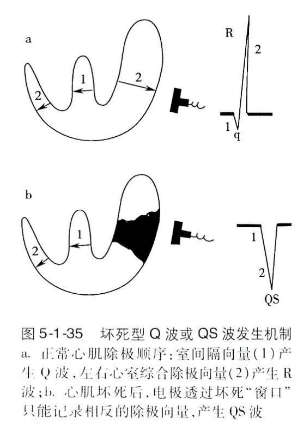 坏死性q波是什么图片