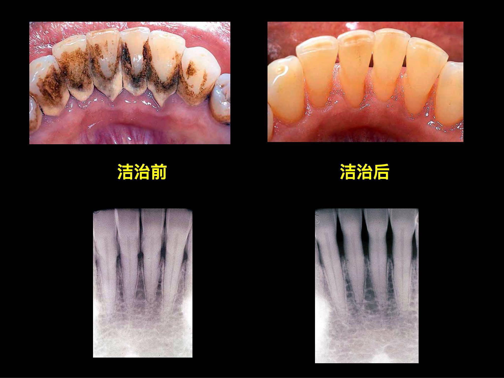 为什么牙齿正畸有的人会牙龈增生，有的人会牙龈萎缩？如果有萎缩（黑三角？）有什么好办法缓解吗？ - 知乎
