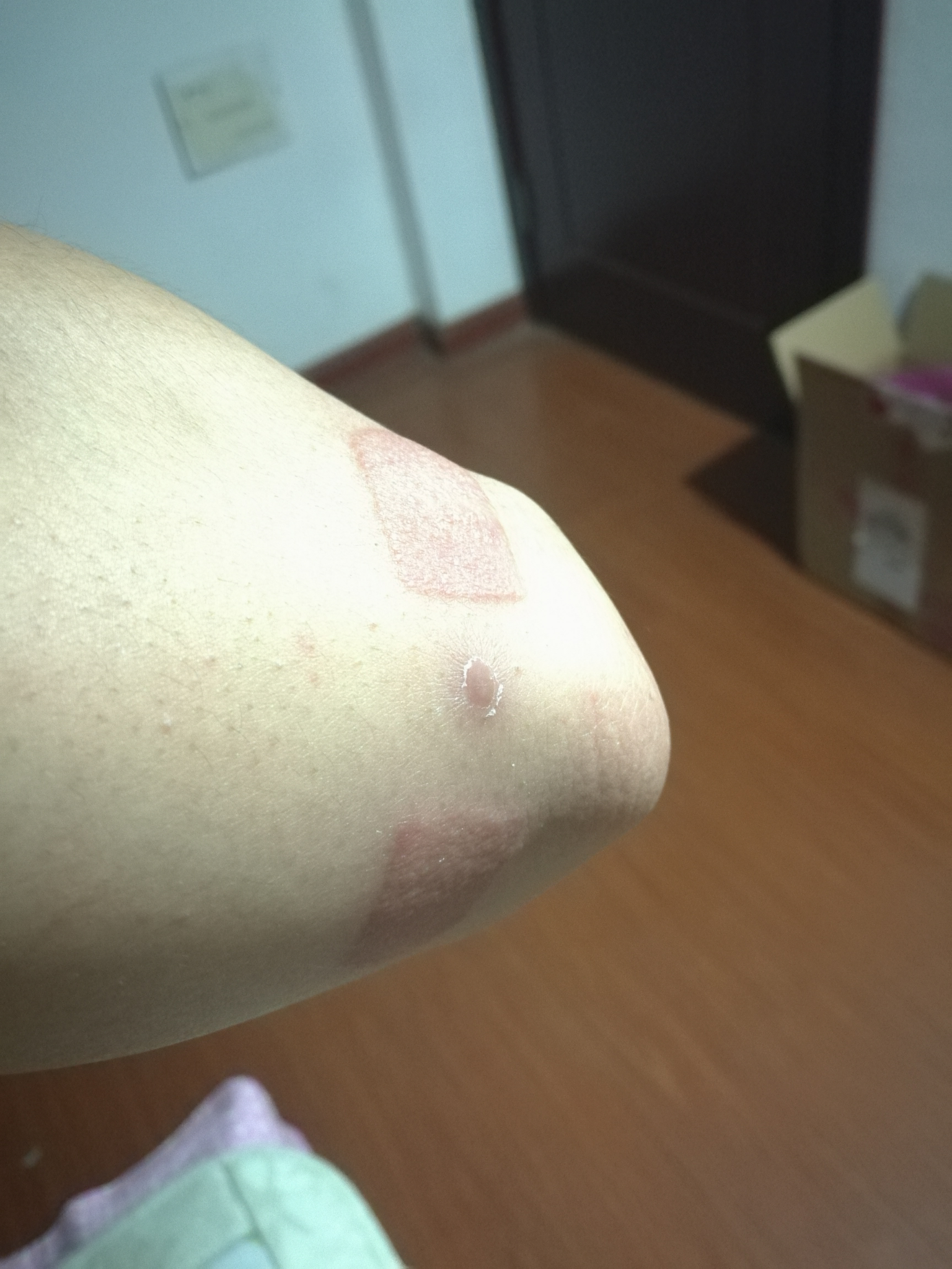 为什么有的人会对创可贴胶布过敏过敏原是什么是过敏吗