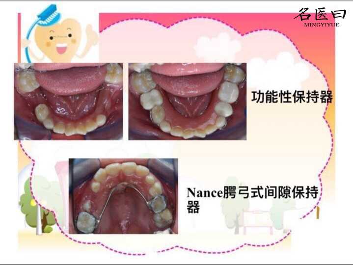 乳牙的根冠治療和間隙保持器