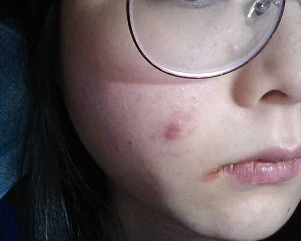 右边脸颊之前是闭合粉刺,现在变成红肿的大痘痘,但是一直不痛不痒,也