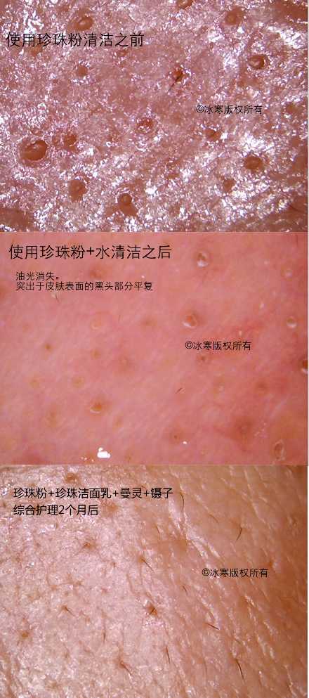 额头上黑头怎么去?