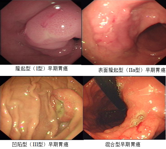 胃癌中期图片