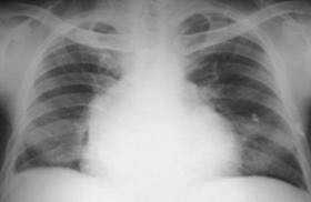 球形心:房室普遍增大,器质性心脏病晚期(也见于新生儿,小儿心脏x片).