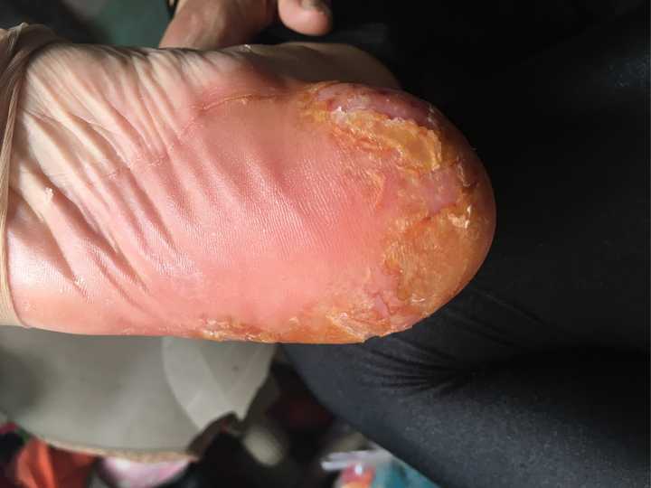 我妈妈52岁脚后跟蜕皮严重蜕皮一层又一层去医院看了开的药膏并没有见
